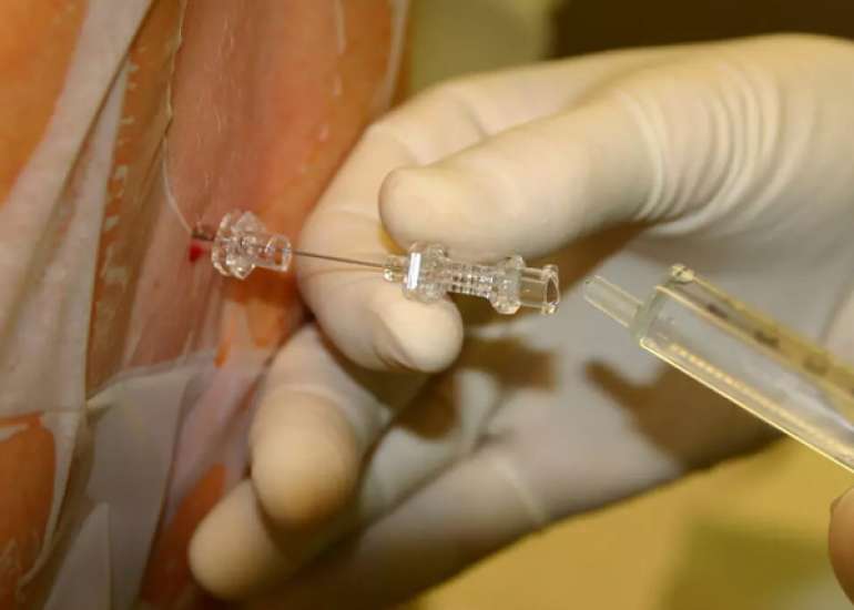 Prophylaxis against post-spinal hypotension in elective C-section: Efficacy of Norepinephrine