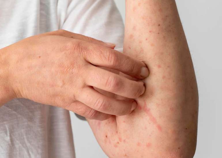 सोरायसिस क्या है? कारण, लक्षण और इलाज | Psoriasis in Hindi