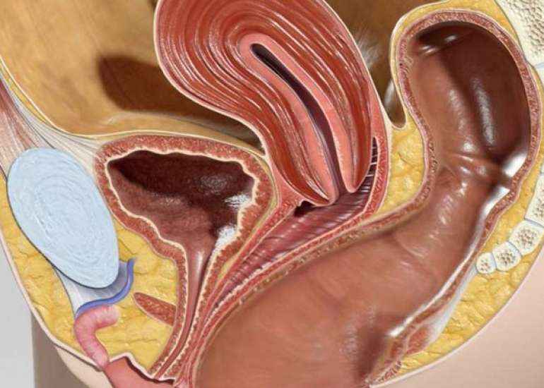 रेक्टोसेले क्या है? कारण, लक्षण और इलाज | Rectocele in Hindi