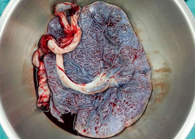 Retained Placenta and Postpartum Hemorrhage