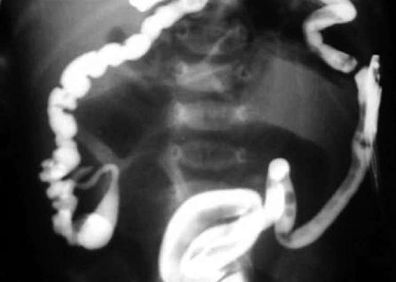 Retrograde diagnosis of total colonic aganglionosis in a female infant: a rare presentation