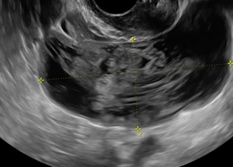 Retroperitoneal Hydropic Leiomyoma Mimicking an Ovarian Cyst