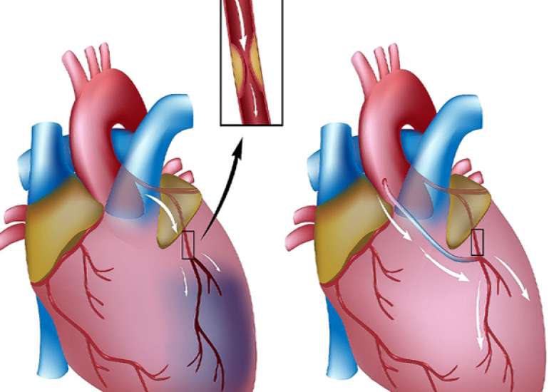 Role of CABG in acute MI?