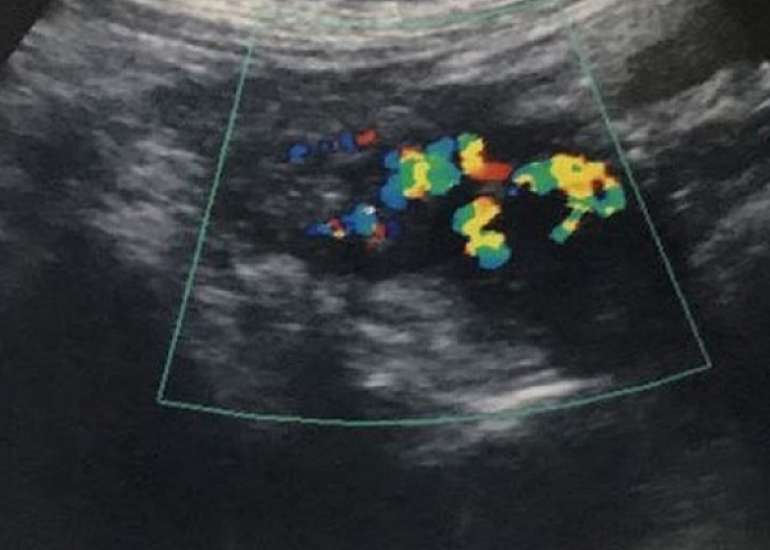 Ruptured Exophytic Uterine Artery Pseudoaneurysm, Seven Days after Vaginal Delivery