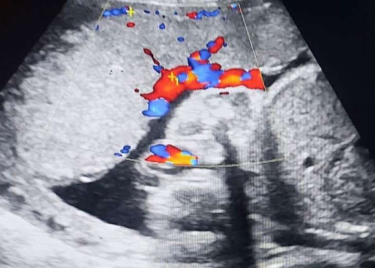 Second-trimester ultrasound, fetal biometrics and gestational diabetes