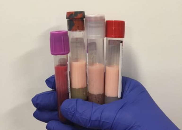 Severe hypertriglyceridemia in a neonate with apolipoprotein A deficiency