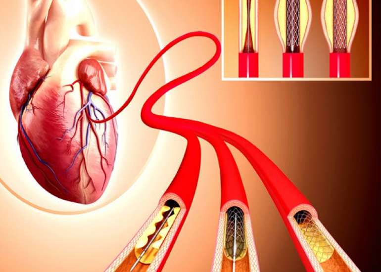 Should angioplasty be performed in coronary artery obstructive disease?