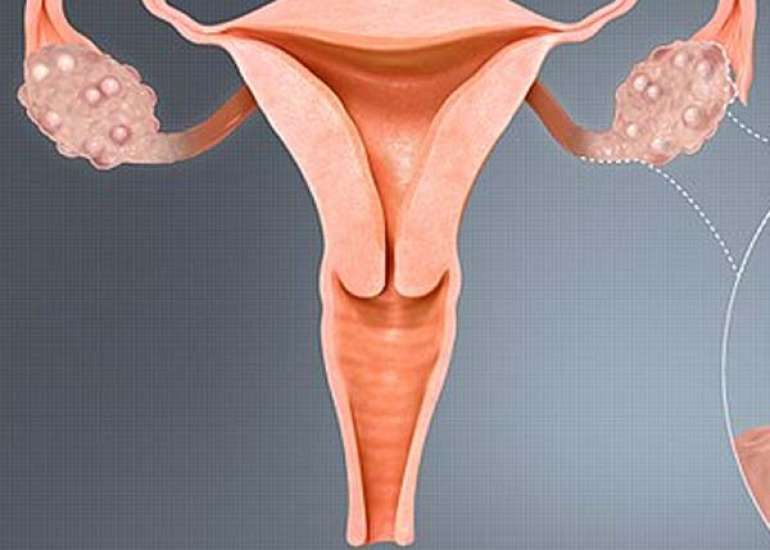 Should We Assess CRP/Albumin Ratio in Polycystic Ovarian Syndrome?