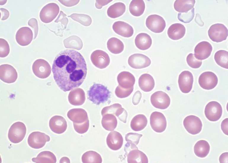 साइडरोबलास्टिक एनीमिया क्या है? कारण, लक्षण और इलाज | Sideroblastic Anemia in Hindi