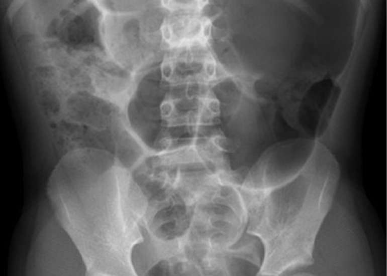 Sigmoidal Volvulus: A Surgical and Gynecological Challenge