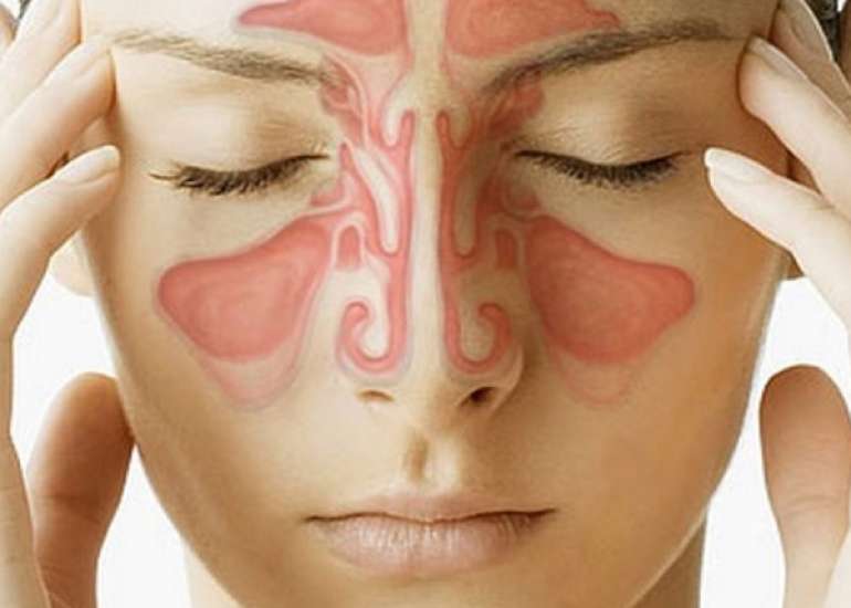 साइनोसाइटिस क्या है? कारण, लक्षण और इलाज | Sinusitis in Hindi