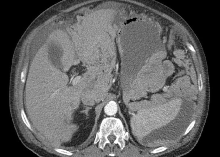 Spontaneous hemoperitoneum in pregnancy