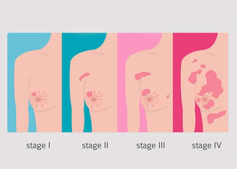 What is staging in Breast Cancer?