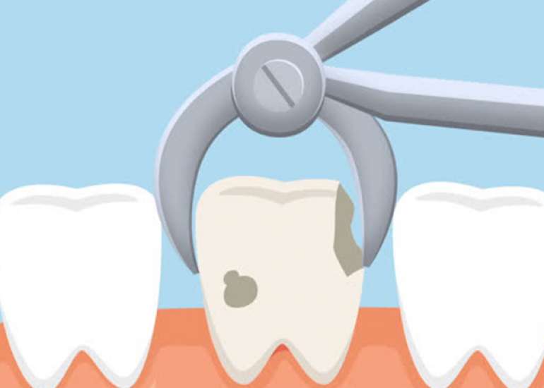 Steps to be taken before Tooth Removal Procedure