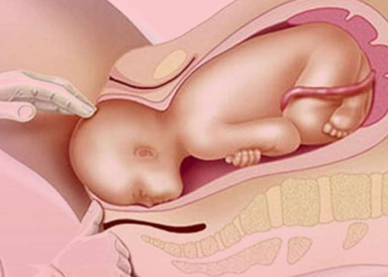 Successful Vaginal Delivery following External Cephalic Version in a Woman with a Large Partial Uterine Septum