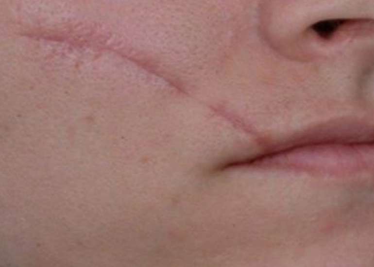 Surgical Scars: How should we Minimize and Treat their Appearance?
