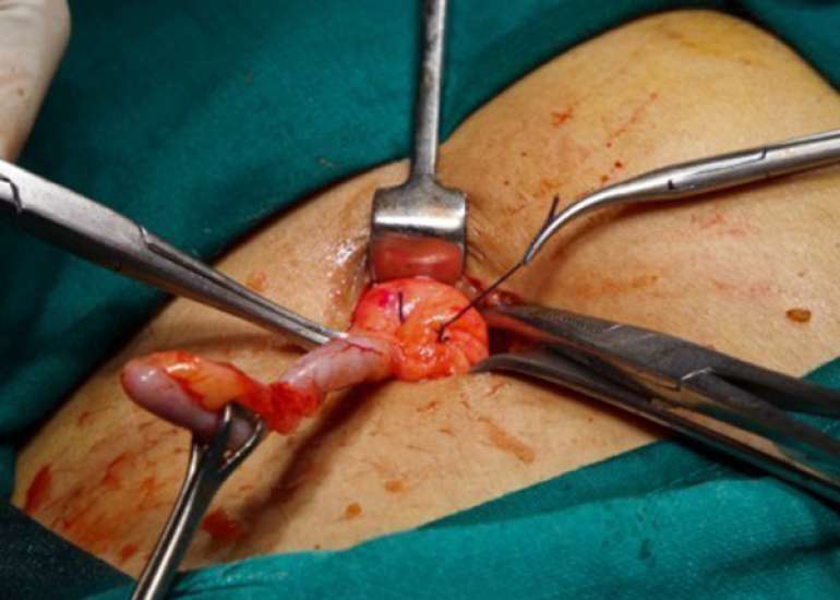 Surgical management of acute appendicitis?