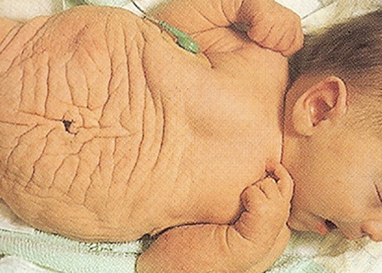 Surgical treatment of an 8-year-old child living with Prune Belly syndrome
