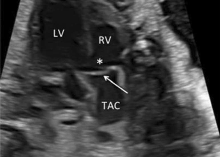 TAC: A Review of Prenatal Diagnosis, Associated Findings, and Postnatal Outcome of Fetuses