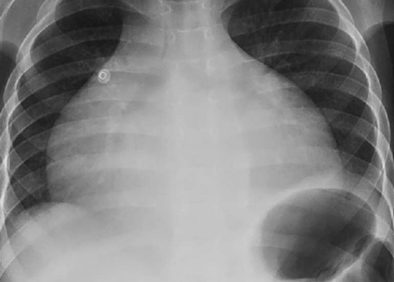 Tachycardia-Induced Cardiomyopathy in 5 years old