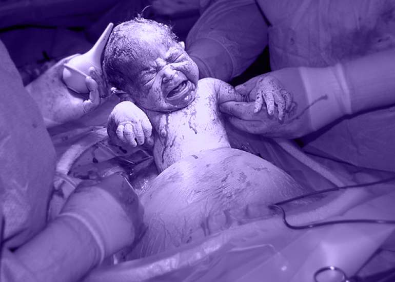 The Impact of Obesity on Blood Loss during Cesarean Delivery