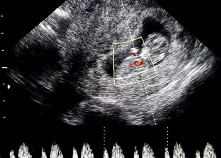 The Link Between Umbilical cord variables and gestational age in normal pregnancy and PIH