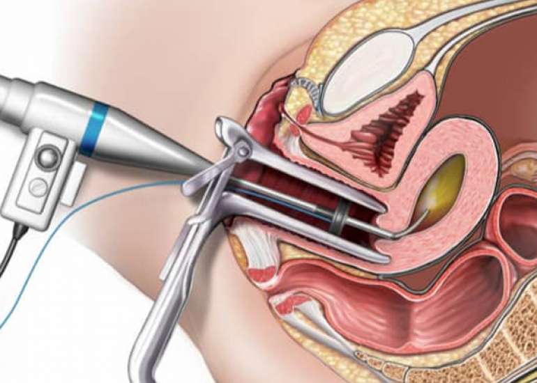 The scope of Ambulatory Hysteroscopy