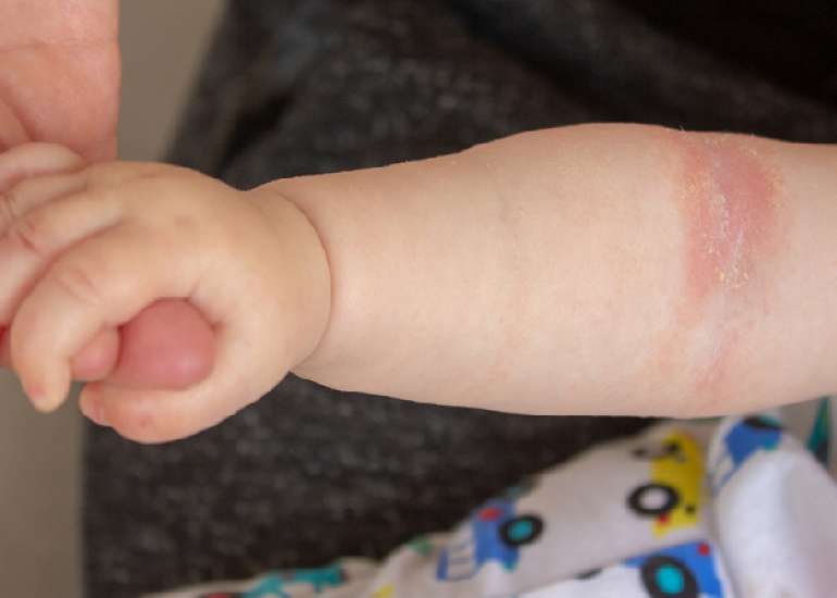 The use of Emollients in infancy prevents atopic dermatitis