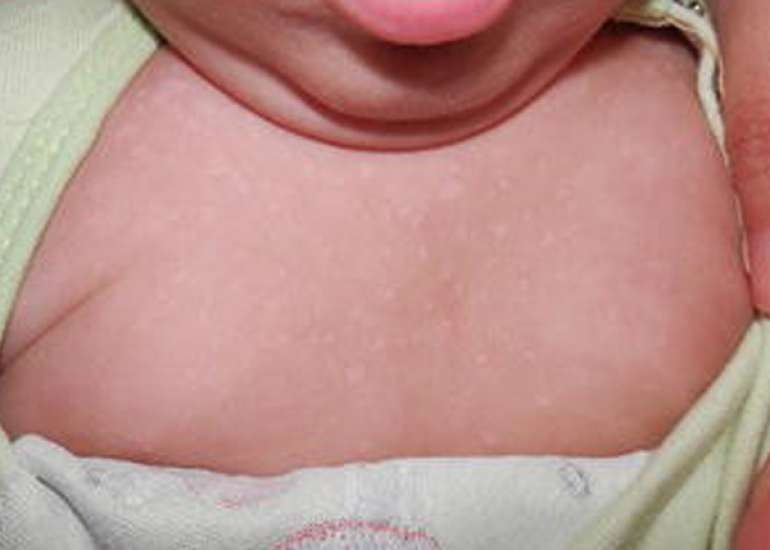 Tinea Versicolor in a Three-Month Infant: A Case Report