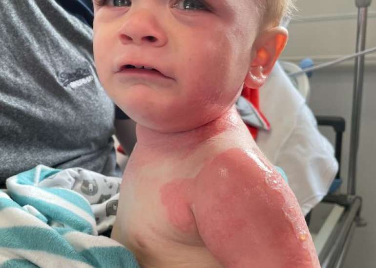 Toxic Shock Syndrome in Children