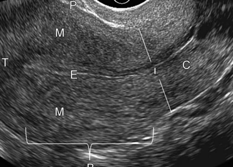 Trans-vaginal ultrasound simulation: An exploratory qualitative research study focused on the end-users perception of learning