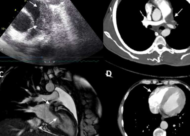 Treatment Response can aid in Determining the Cause of Unusual Recurrent Intracardiac Masses