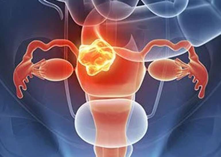Treatment of endometriosis: a review with comparison of eight guidelines