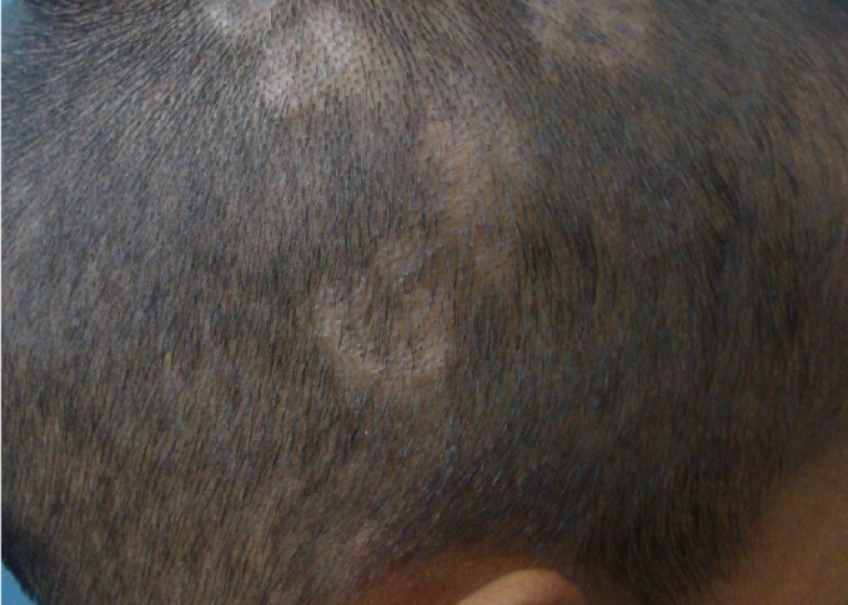 Trichoscopy for Tinea Capitis