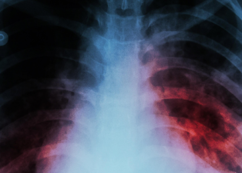 Tuberculosis in an Infant with IL-7 Receptor Deficiency