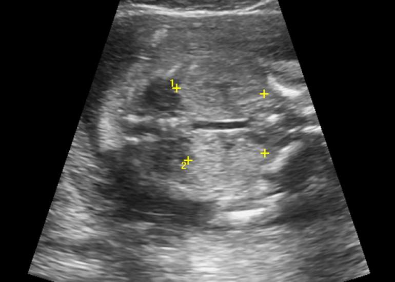 Ultrasound Identification of Morphological features in Trisomy 13 (Patau's Syndrome) Fetuses