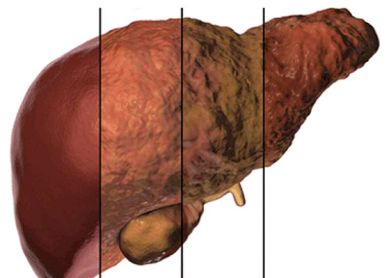 Understanding NAFLD & NASH