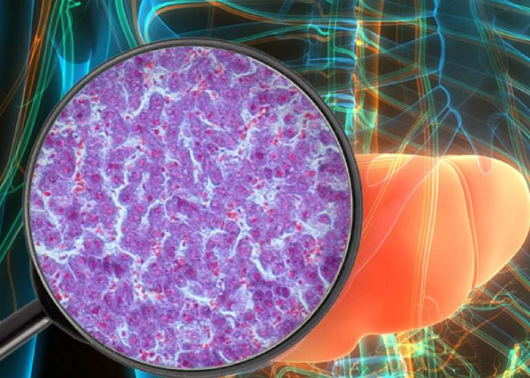 Understanding and Differentiating! NAFLD and NASH