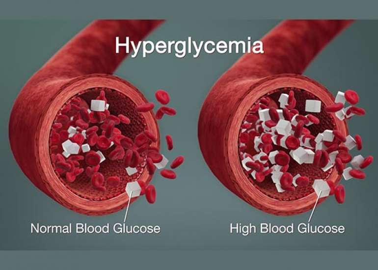 Understanding white coat hyperglycemia?