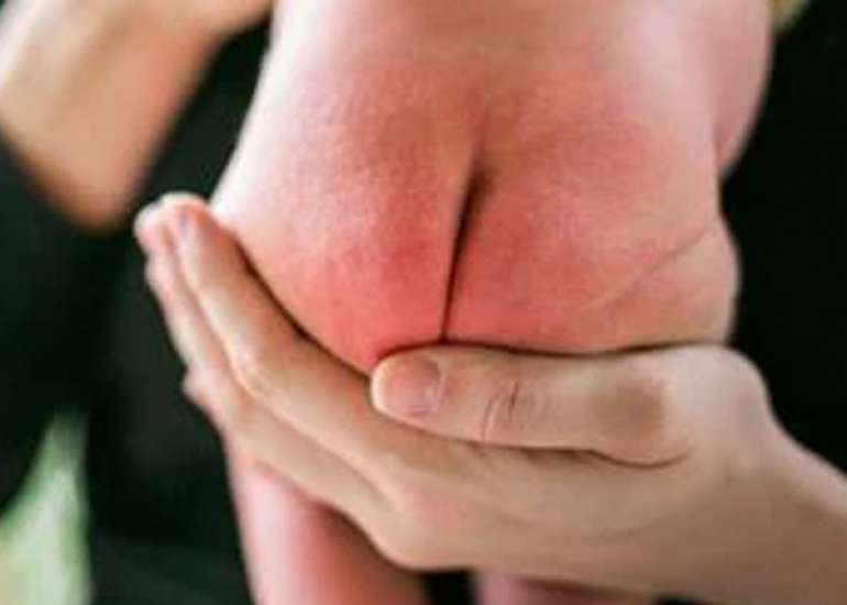 Unusual diaper dermatitis