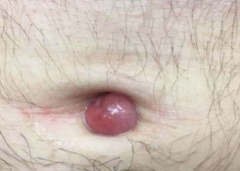 Urachal Anomalies during Infancy