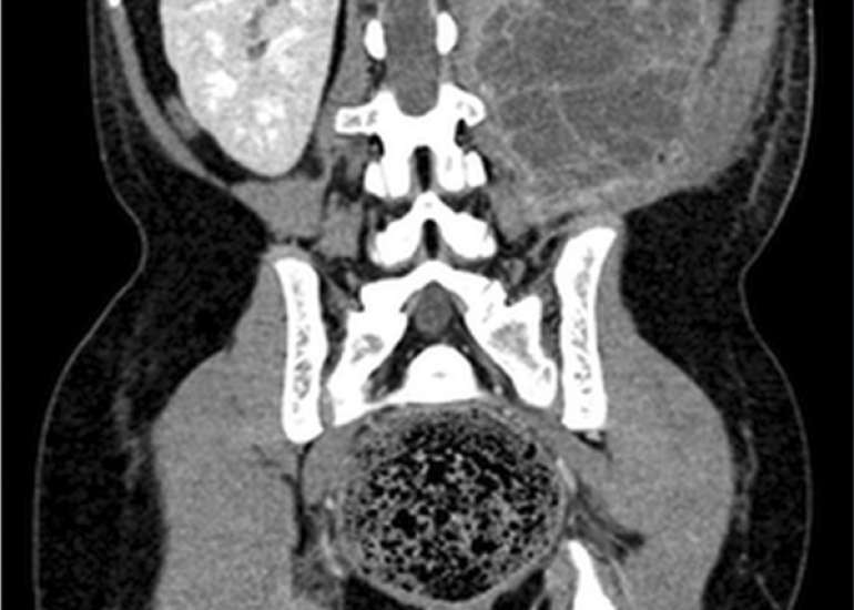 Urolithiasis with pyonephrosis in a child