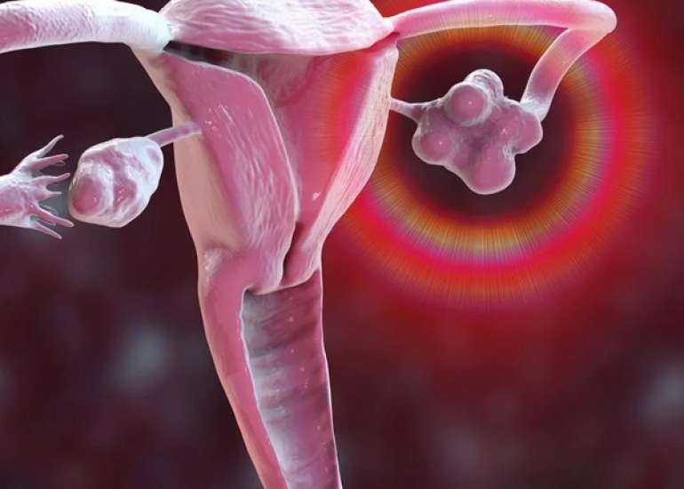 Use of Triglyceride and glucose index in women with polycystic ovary syndrome