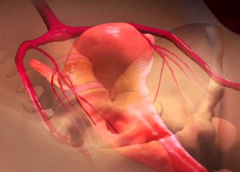 Uterine Necrosis following Uterine Artery Embolization for PPH