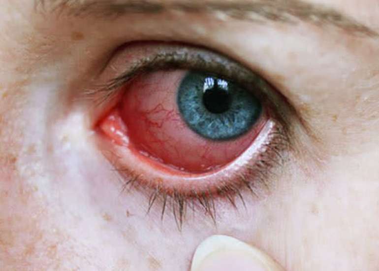 यूवाइटिस क्या है? कारण, लक्षण और इलाज | Uveitis in Hindi