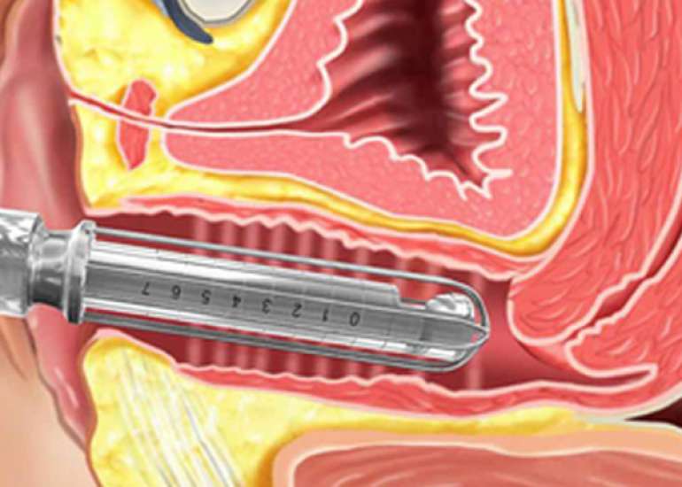 Vaginal laser therapy for gynecologic conditions: re-examining the controversy and where do we go from here