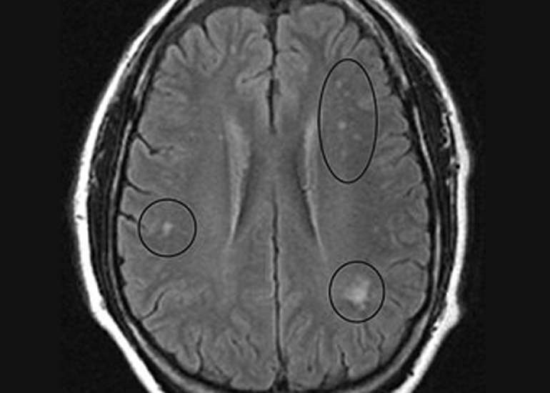 Vitamin B12 Deficiency Can Lead to Reversible Basal Ganglia Changes in Infants: A Case Study