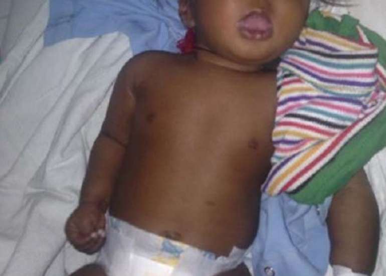 Voice loss in Infantile Tremor Syndrome