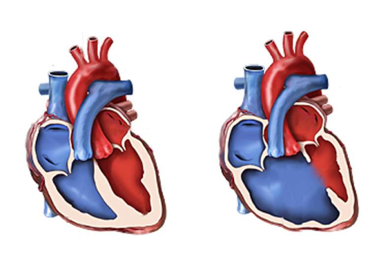 What is congenital heart disease?