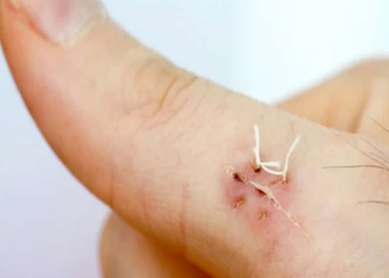 What are dissolving stitches made of? What do they dissolve in?